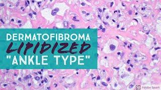 Dermatofibroma, Lipidized ("Ankle Type")...Explained by a Dermatopathologist