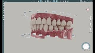 Spaces Visualization in Aligner Treatment Planning Software