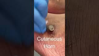 Cutaneous horn watch the removal on my channel! #cutaneoushorn #feet #podiatry #footcare