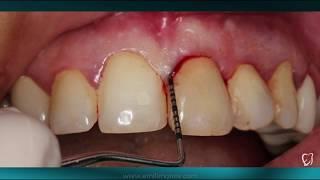 Preserving natural contour of the soft tissue during IMPLANT SURGERY (IMPLANTOLOGIST Dr.EMIL IMANOV)