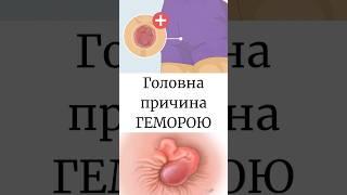 Геморой, причина та як його запобігти