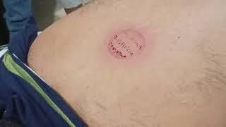 Wet Cupping Therapy (Hijama)