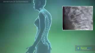 Оsteoporosis Definition