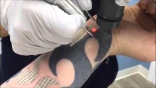 Laser Tattoo Removal 1st Treatment,Skin Deep, Burke VA, Fairfax County VA, Northern VA