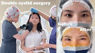 公开双眼皮过程 double eyelids surgery in MALAYSIA