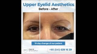 Upper Eyelied (Blepharoplasty) Surgery - Before & After | mezMD Health Tourism Agency