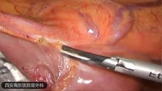 superior mesenteric artery compression syndrome 肠系膜上动脉压迫综合症