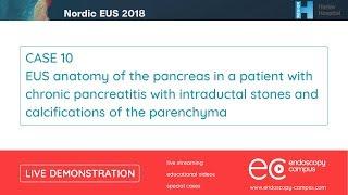 Livedemo | Nordic EUS 2018 | EUS anatomy of the pancreas in a patient with chronic pancreatitis