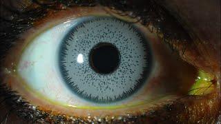 Bright Ocular Iris implants- modified removal technique