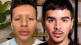 My EYEBROW TRANSPLANT Experience | Gabriel Zamora