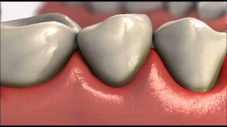 Understanding Gum Disease From Colgate