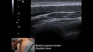 Ultrasound-guided 5-in-1 injection for non-specific upper back pain