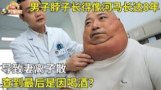 男子脖子长得像河马长达8年,导致妻离子散,查到最后是因喝酒?【真相纪实】