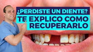 PERDÍ un DIENTE  ¿Qúe Hago? 3+1 SOLUCIONES Posibles 