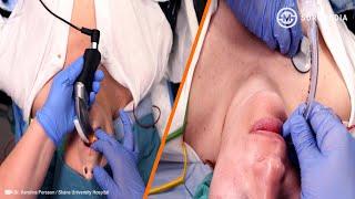 Endotracheal Intubation