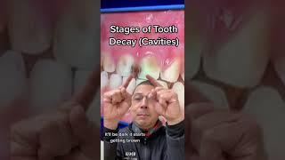 Explaining the Stages of Tooth Decay (Cavities) | View Mobile Dental