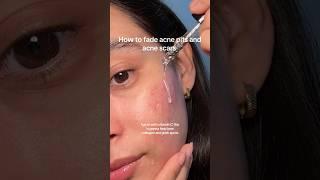 How to fade acne pits & acne scars.#skintransformation #acnescars #acnescarsremoval