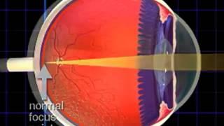 Nearsightedness and Farsightedness