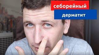 Себорейный дерматит, часть вторая. Что мне помогает, а что не дает эффекта (личный опыт)