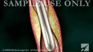 Balloon Angioplasty - ANC00203