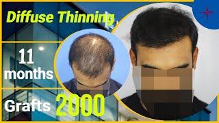 Hair Transplantation II Diffuse Thinning II 2000 Grafts@EugenixHairSciencesofficialby experts