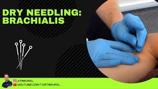 Dry Needling: Brachialis