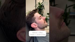 Before + After: Cheek + Jawline Filler