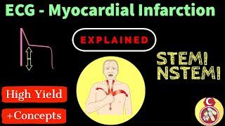 ECG Crash course - #14 Myocardial Infarction (STEMI - NSTEMI)