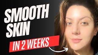 Smooth Skin in 2 weeks. Treatment for bumpy textured skin! Full routine | Nipun Kapur