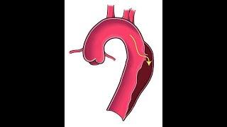 Dissecting Aortic Aneurysms: learn how to classify them and about some of their deadly complications