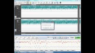 Start quickly and easy  an aEEG recording