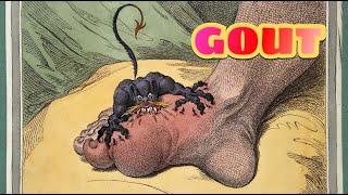 Gout and Pseudogout (updated 2023) - CRASH! Medical Review Series