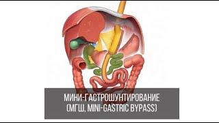 Мини-гастрошунтирование (МГШ, Mini-Gastric Bypass)