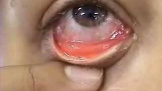 Conjuntivitis