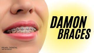 DAMON BRACES: ALL YOU NEED TO KNOW ABOUT