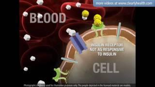 Diabetes: Sulfonylureas medication