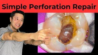 Perforation Repair SECRETS Every Dentist Needs to Know!