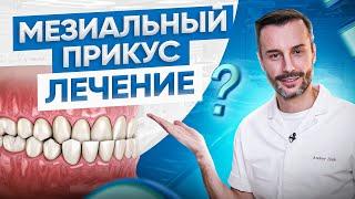 Виды неправильного прикуса у человека #3 | Мезиальный прикус