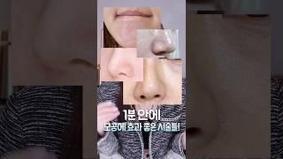 모공에 효과 좋은 시술 50초로 정리해드림 #모공 #피부과시술추천