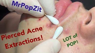 NEW EXTRACTION VIDEO! Pierced acne. Blackheads, whiteheads, ingrown hairs. Tons of pop! Must see!