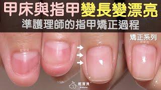 Prospective therapist's nail correction process-nail beds and nails become longer and more beautiful