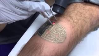 Laser Tattoo Removal, Skin Deep Laser Services, Burke VA, Fairfax County VA, Northern VA