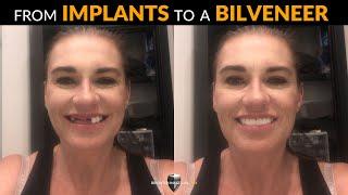 Dental Implants for Missing Teeth? Think Again! Brighter Image Lab Smile Makeovers from Home!