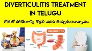 DIVERTICULITIS TREATMENT IN TELUGU | Telugu Tips