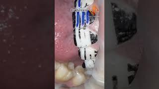 Guided wearing technique on resin #dentist #shorts