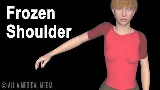 Frozen Shoulder (Adhesive Capsulitis), Animation.