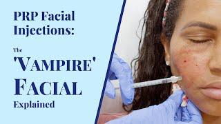 The 'Vampire' Facial: Explained | PRP Facial Injections at BYou Laser Clinic