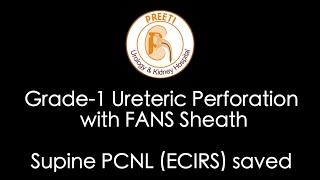 Grade-1 Ureteric Perforation with FANS Sheath - Supine PCNL (ECIRS) saved