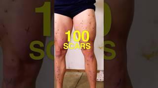 How I got 100+ SCARS! #science #health #fitness