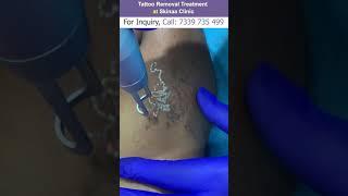 Laser Tattoo Removal at Skinaa Clinic l Viral #shorts